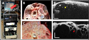 pancreatic-cancer