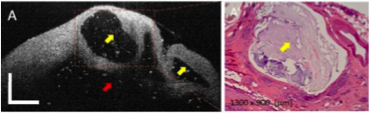 pancreatic-cancer1