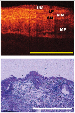 esophageal1