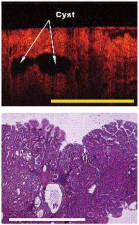 esophageal2