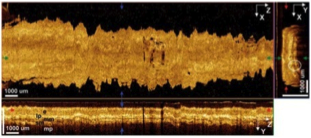 esophageal4