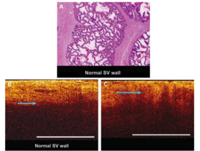 prostate-cancer1