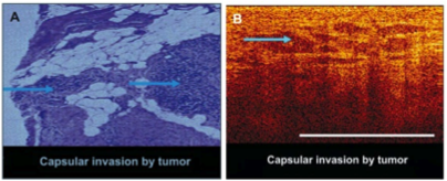 prostate-cancer2