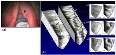 vocal-cord1